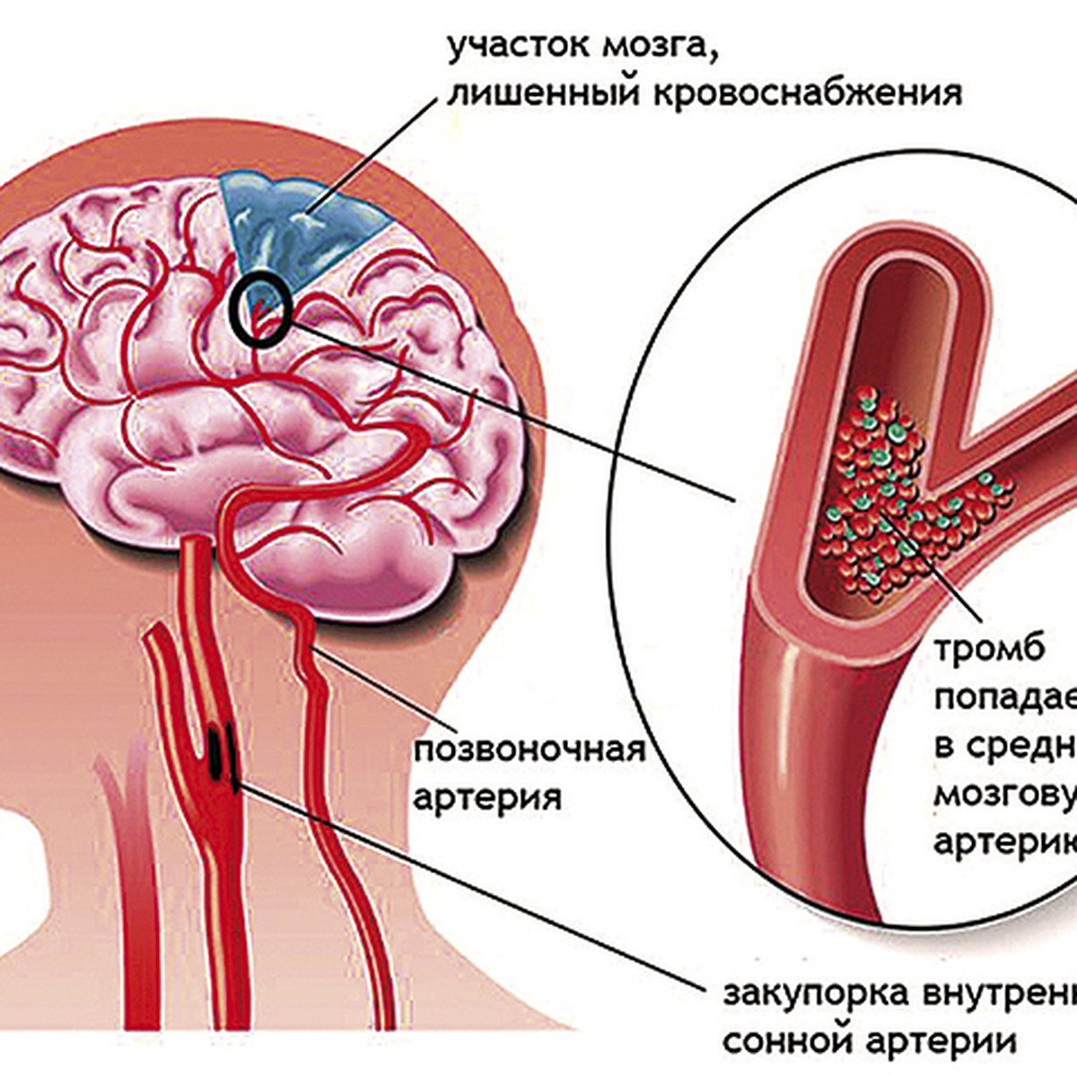 Что такое «тихий» инсульт ? - KP.RU