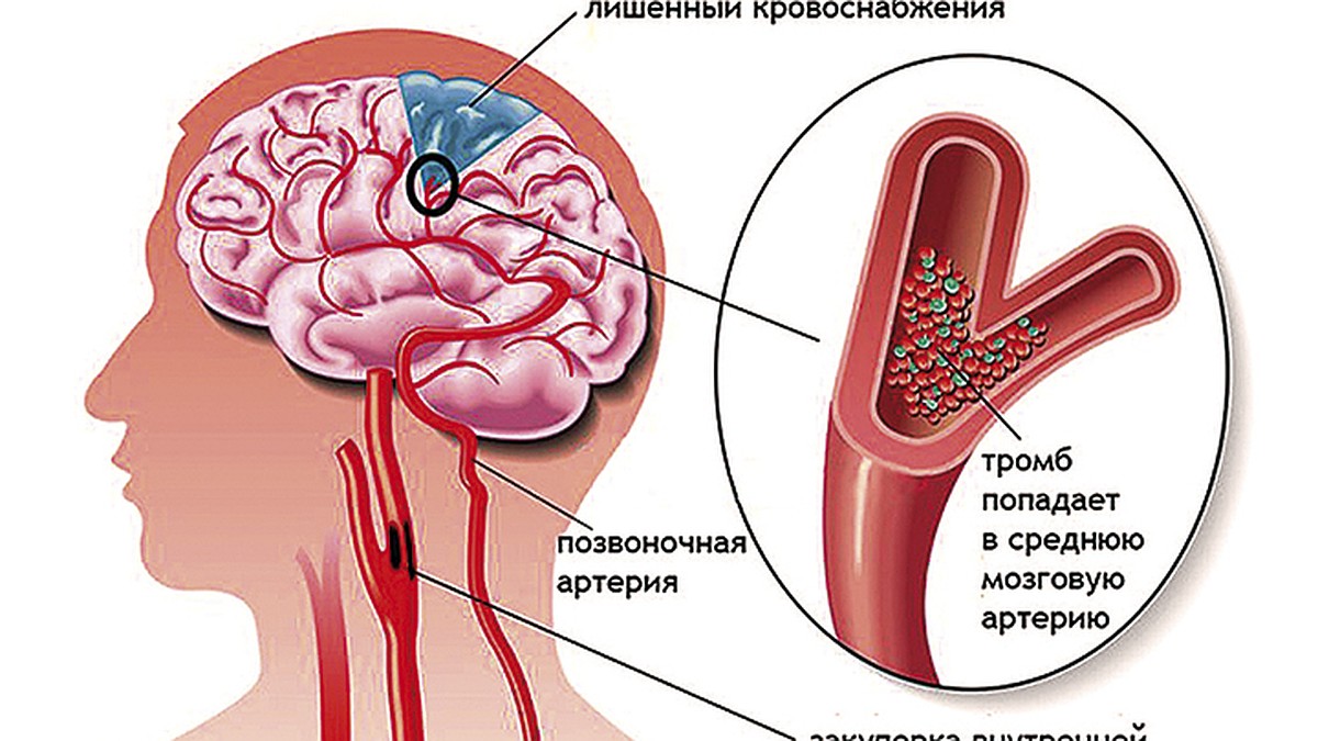 Что такое «тихий» инсульт ? - KP.RU