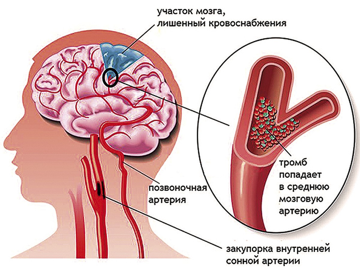 Что такое «тихий» инсульт ? - KP.RU