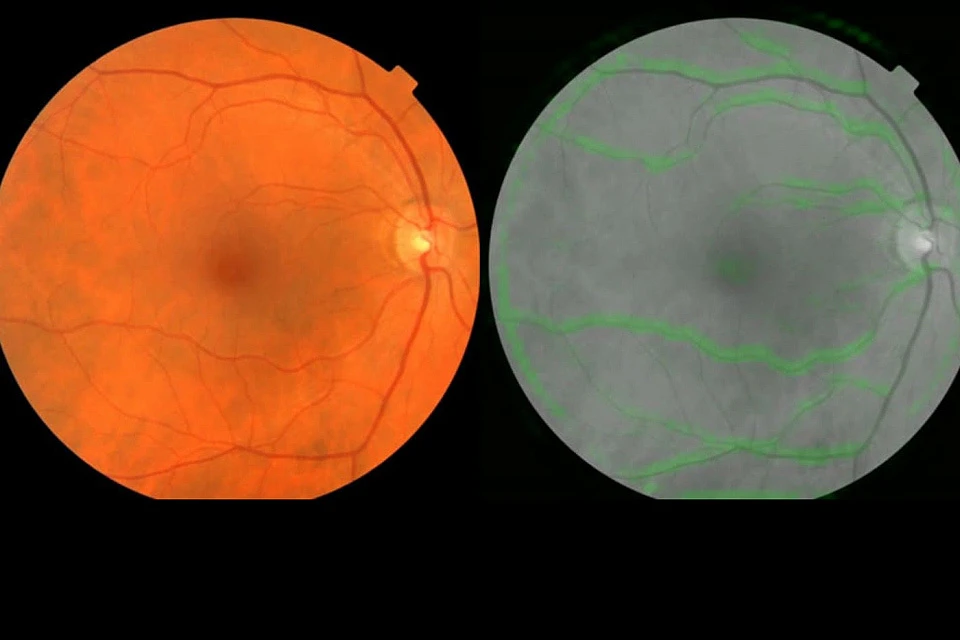 Алгоритм Google изучает изображения сетчатки - фотографии, которые показывают кровеносные сосуды в глазу.