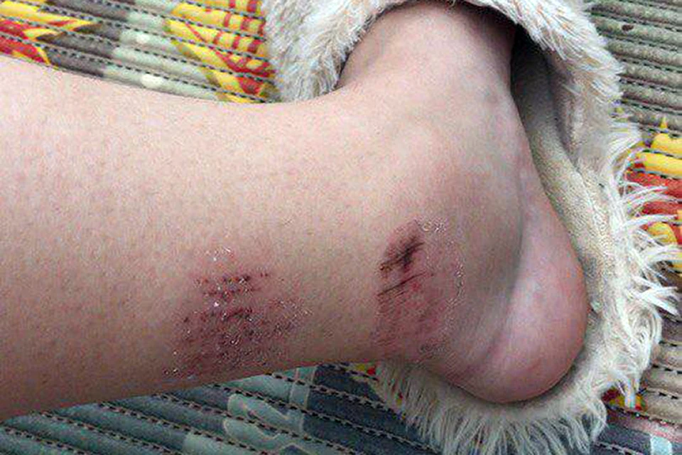 После происшествия врачи диагностировали у Люды телесные повреждения обеих голеней и ссадины на ногах