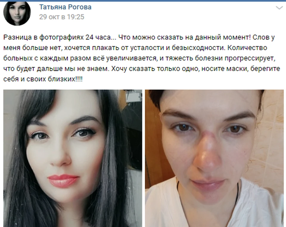 Смена в "красной зоне" оставляет на лице жуткие следы.
