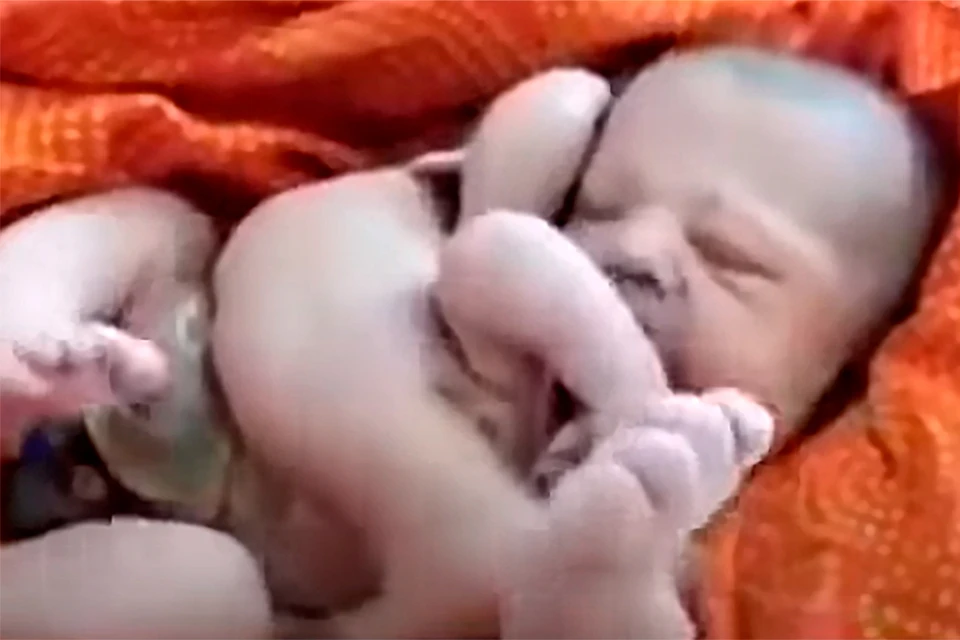 В Индии родился ребенок с четырьмя руками и четырьмя ногами.