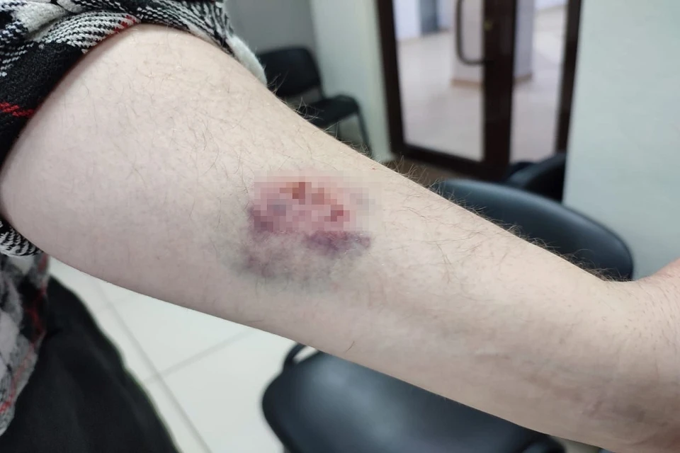 Новосибирцу пришлось ставить прививку от столбняка после укуса неадекватного мужчины. Фото: предоставлено Сергеем.