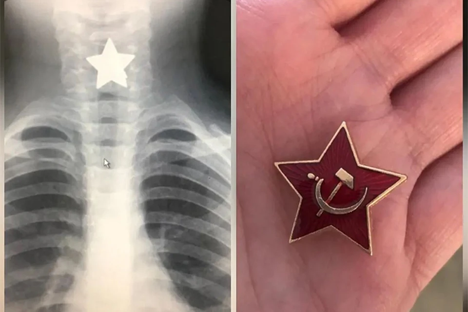 Врачи были шокированы, когда увидели на рентгеновском снимке значок с такими острыми краями. Фото: социальные сети городской клинической больницы Пятигорска.