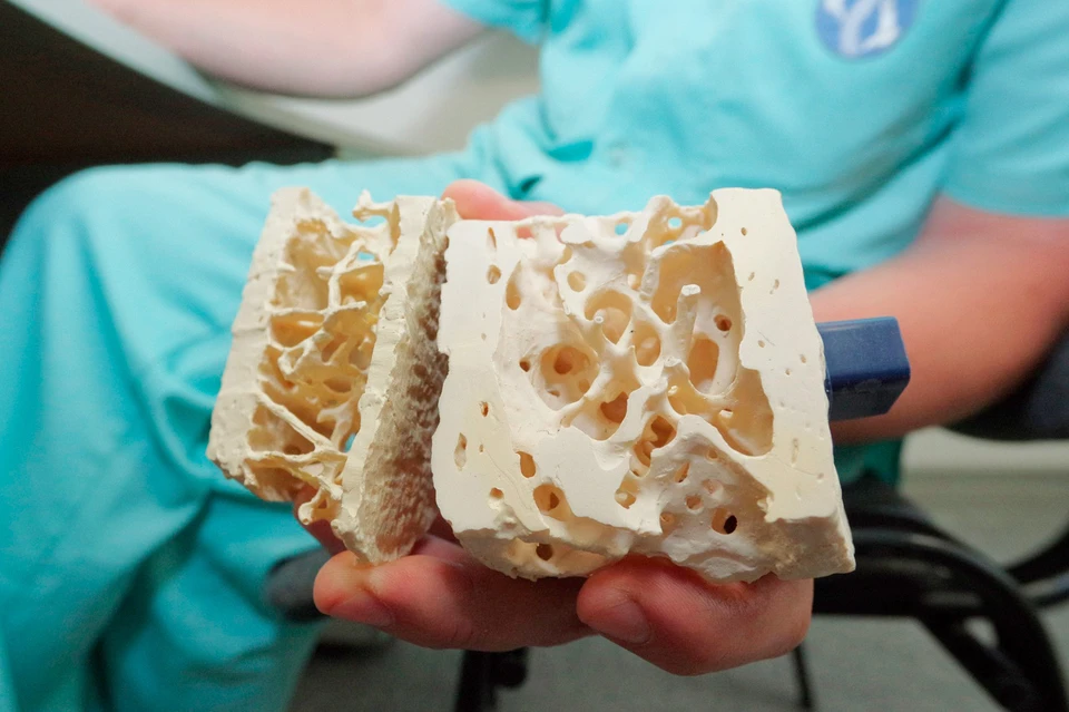 Справа в руке врача макет здоровой кости, слева - подверженной остеопорозу. Фото: Евгений СТУПАК