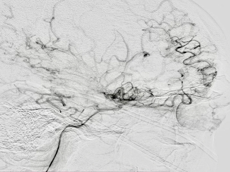 При болезни Мойа-мойа на ангиограмме мозга появляется «легкая сигаретная дымка». Фото: облздрав