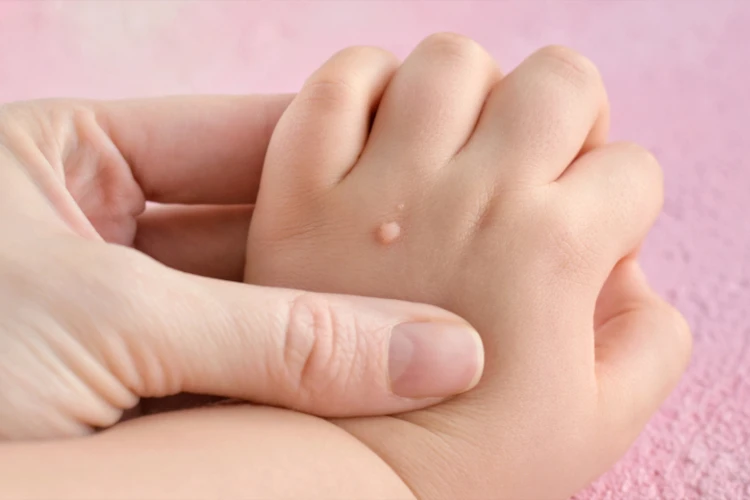 Как избавиться от бородавок: обзор средств и советы дерматолога