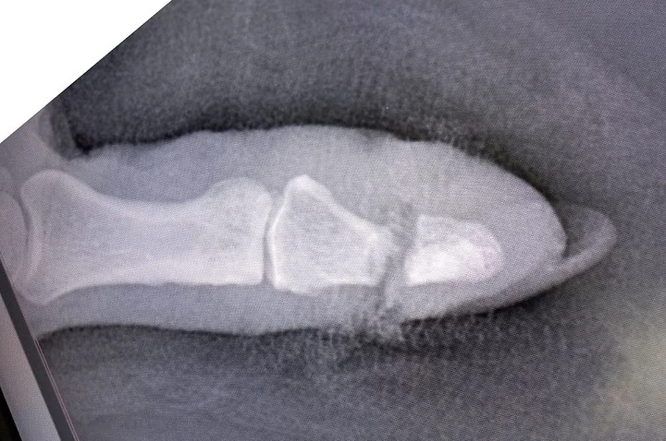 За месяц несколько жительниц Ярославля отрезали себе пальцы секаторами. ФОТО: ГАУЗ ЯО Клиническая больница им. Н.В.Соловьева