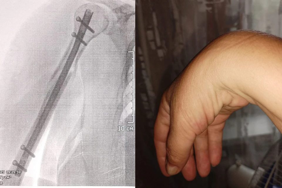 Врачи поставили титановый стержень, но кисть осталась парализована. Фото: Предоставлено пациенткой