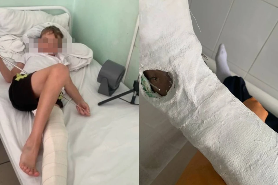 Пострадавший третьеклассник был доставлен в больницу со сложными переломами