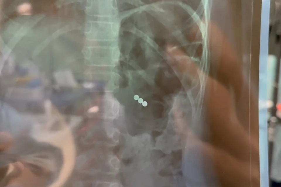 Школьница проглотила магниты во время игры. Фото: соцсети Юрия Козлова.