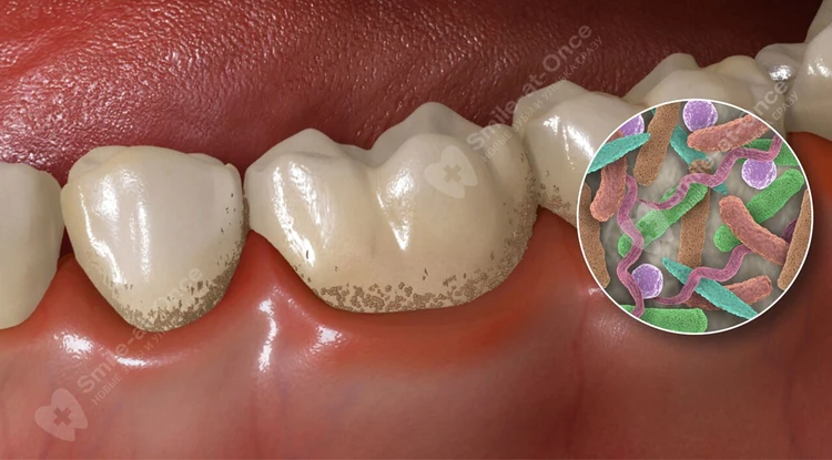 Воспаление корня зуба: симптомы и лечение